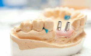 implant dentaire