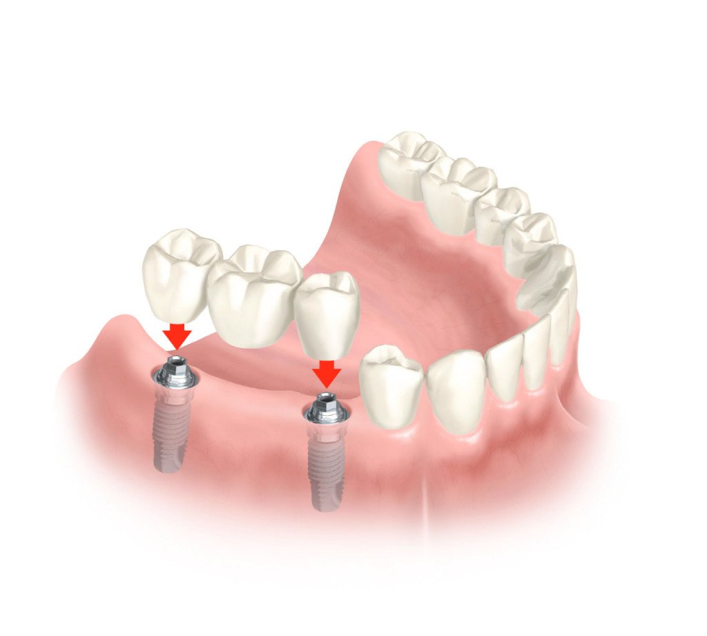 bridge de 3 unité sur implants