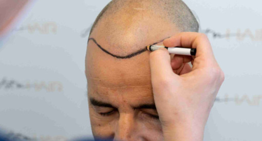 greffe de cheveux de cedric