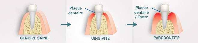 evolution gingivite