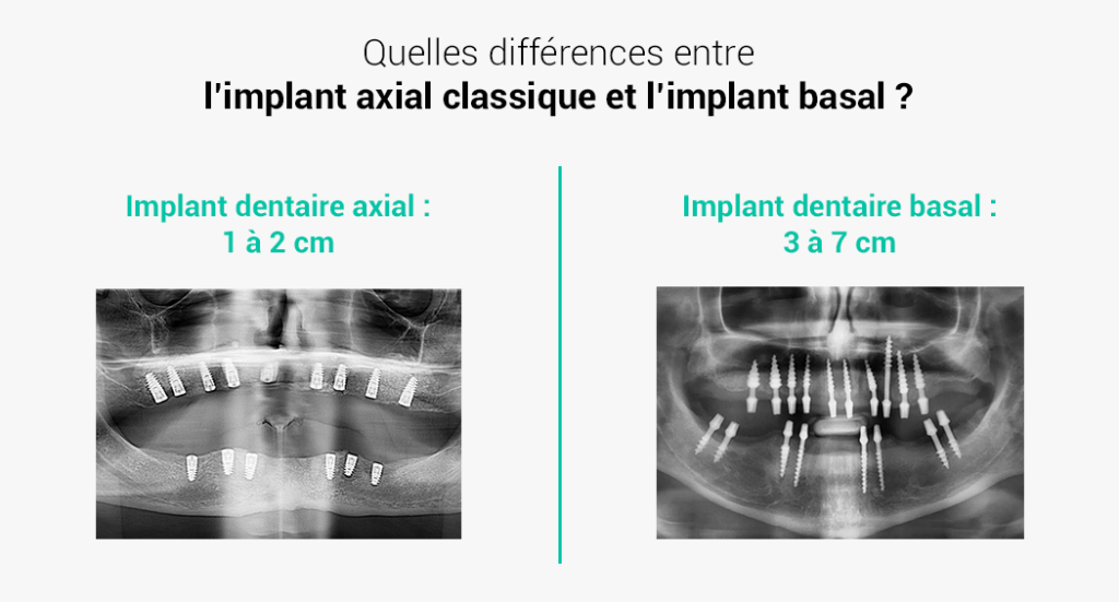 implant dentaire axial vs basal