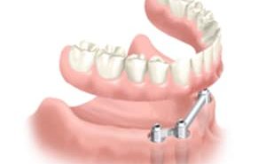 prothèse stabilisée sur implant