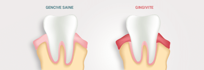 gencive saine vs gingivite