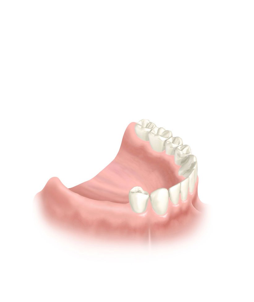 bridge complet dents manquantes