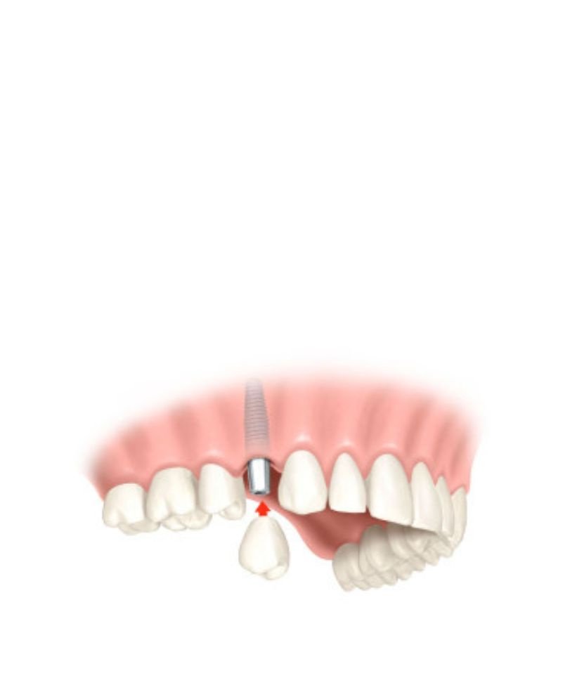 couronne dentaire sur implant pose couronne