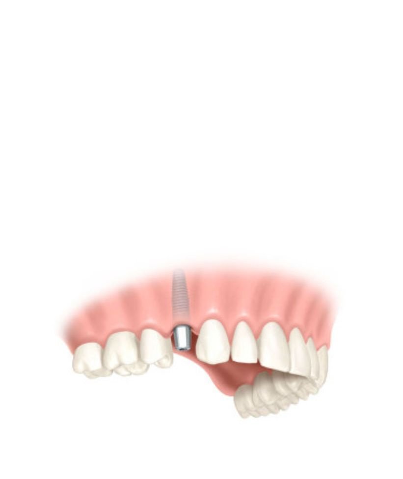 couronne dentaire sur implant pose de l'implant