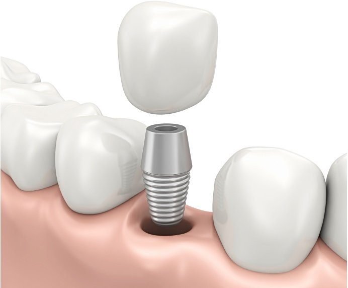 couronne sur implant dentaire