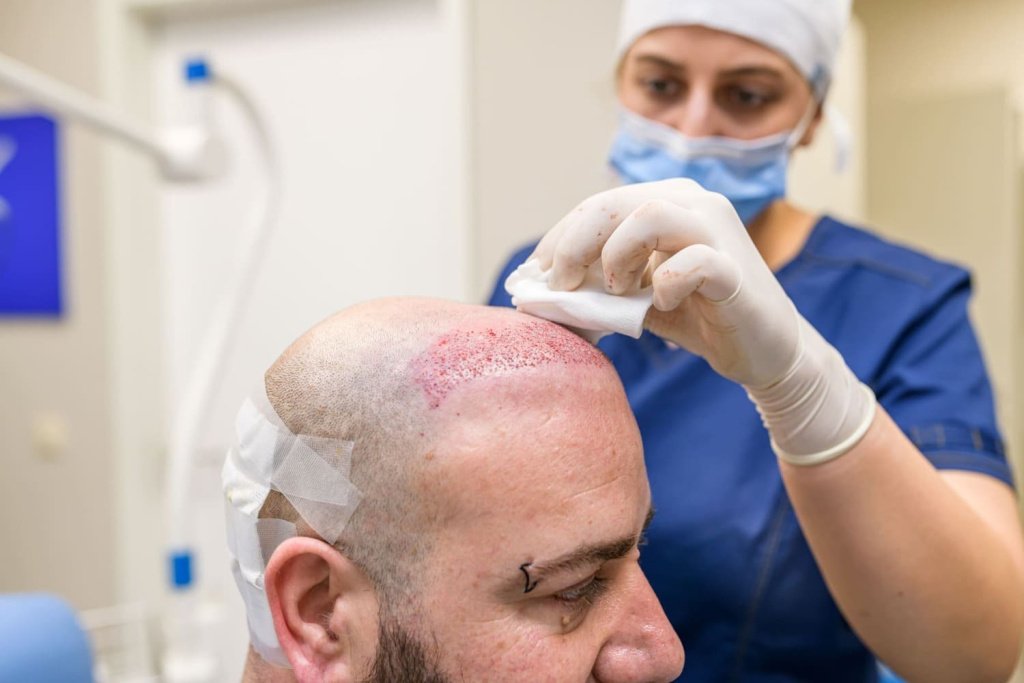 greffe de cheveux conseils postopératoires