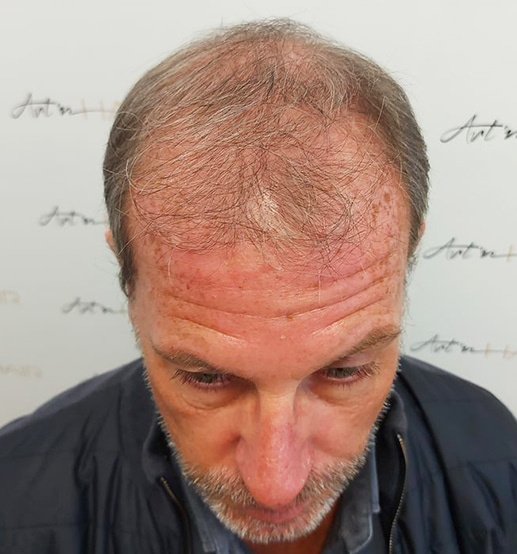 greffe de cheveux david avant