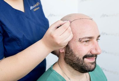 greffe de cheveux et douleur