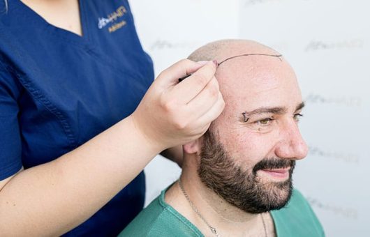 greffe de cheveux et douleur