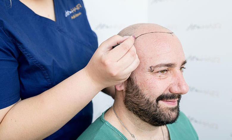 greffe de cheveux et douleur