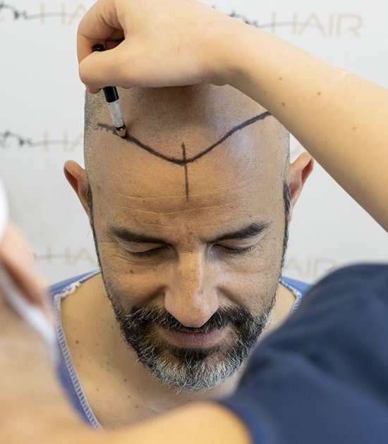 dessin ligne frontale pour greffe de cheveux