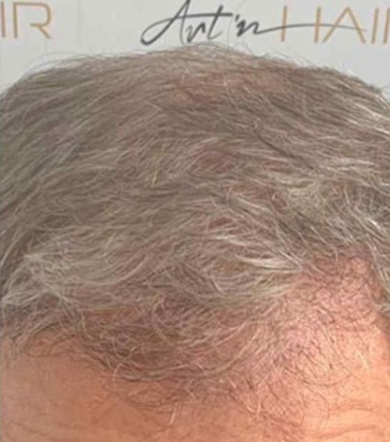 Greffe sur cheveux clairs après
