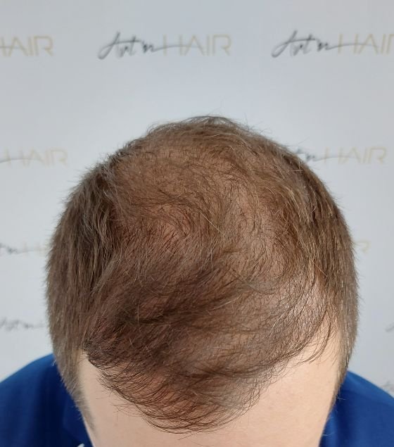 Greffe sur cheveux clairs après