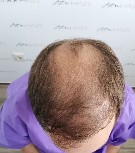 Greffe sur cheveux clairs avant