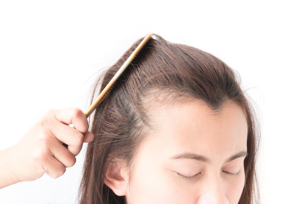 perte de cheveux femme