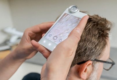 greffe de cheveux zone donneuse