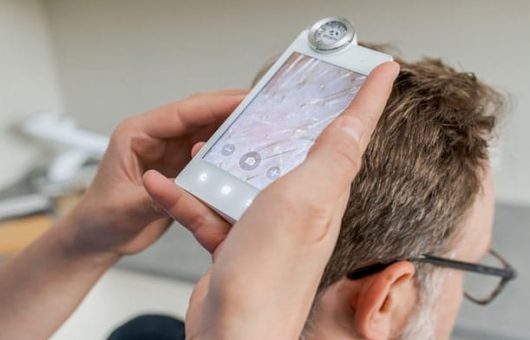greffe de cheveux zone donneuse