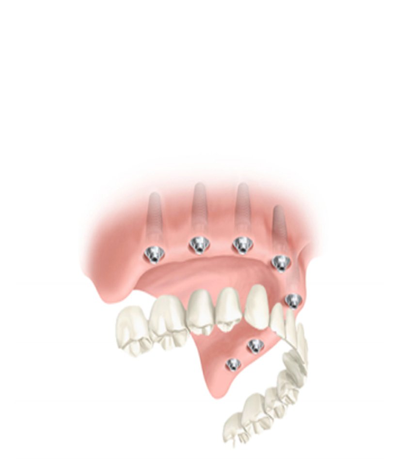 bridge complet implant sur implant