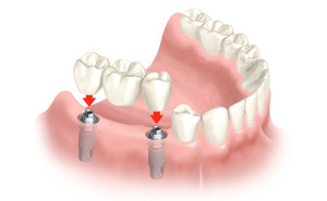 bridge dentaire sur implant