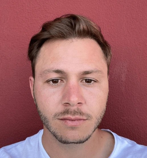 greffe de cheveux après alex
