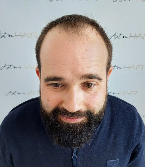 greffe de cheveux avant david