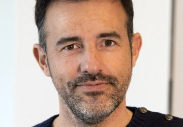 greffe de cheveux cédric 12 mois après