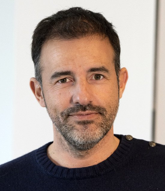 greffe de cheveux cédric 12 mois après