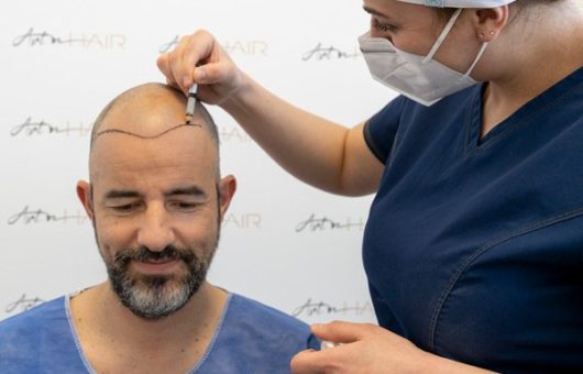 greffe de cheveux pas cher