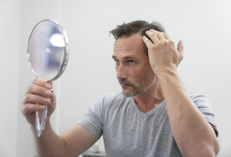 résultat greffe de cheveux 1 mois