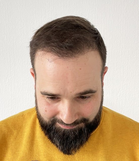 greffe de cheveux après 12 mois david