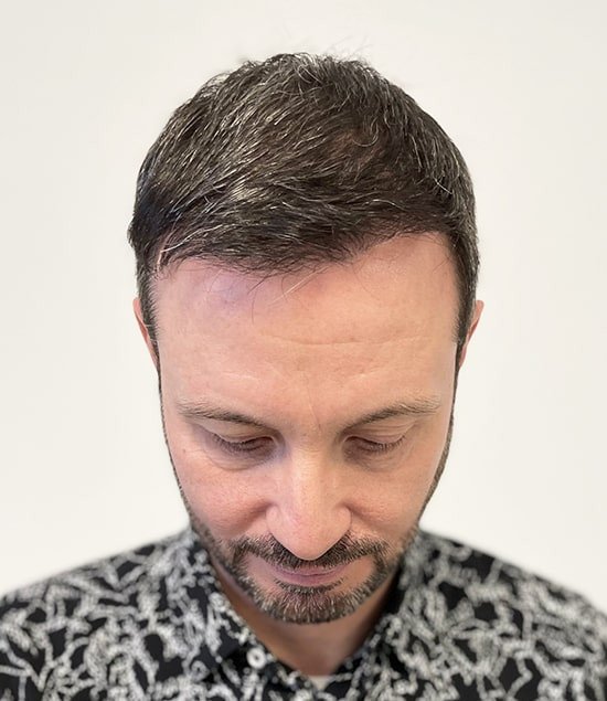 greffe de cheveux après 12 mois jérôme