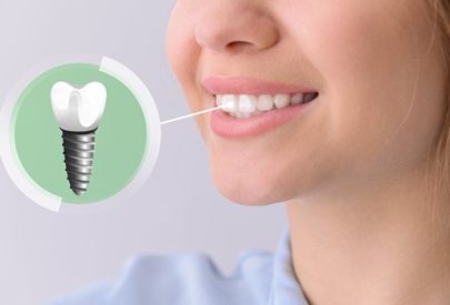 jeune femme avec implant dentaire