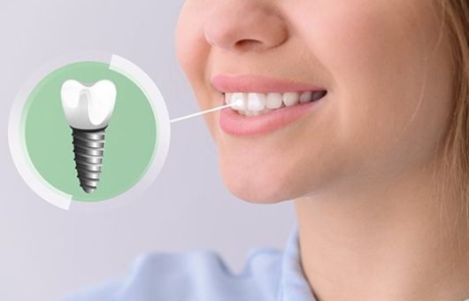 jeune femme avec implant dentaire