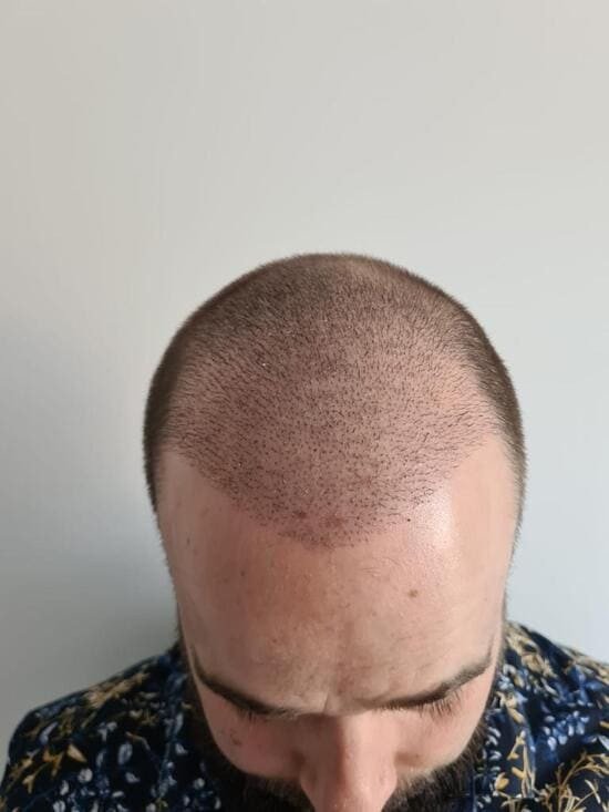 David 1 mois apres une greffe de cheveux