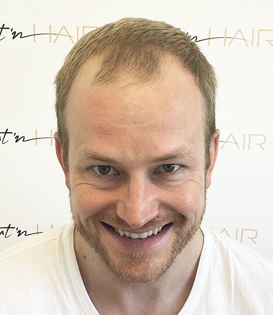 Fabian avant sa greffe de cheveux