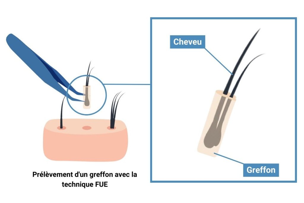 greffon-greffe-capillaire-fue
