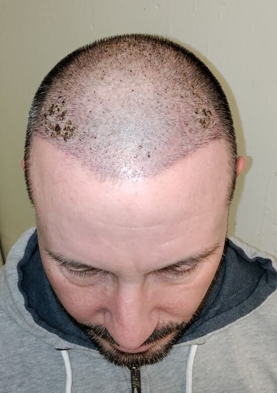patient apres greffe de cheveux 10 jours