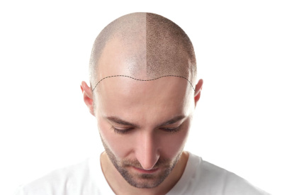 saison idéale pour une greffe de cheveux
