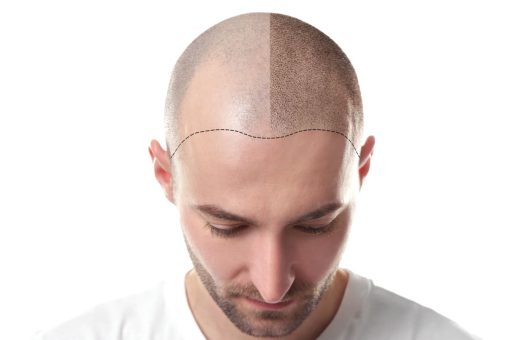 saison idéale pour une greffe de cheveux
