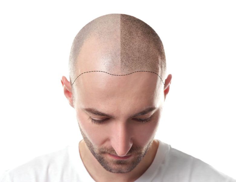 saison idéale pour une greffe de cheveux