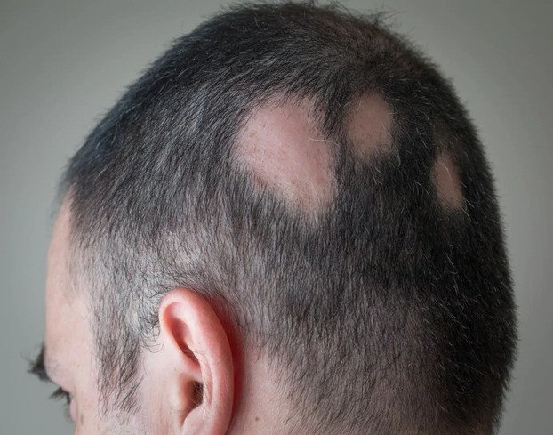 Alopecia Aerata - Calvitie ponctuelle
