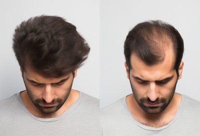 calvitie pelade différences