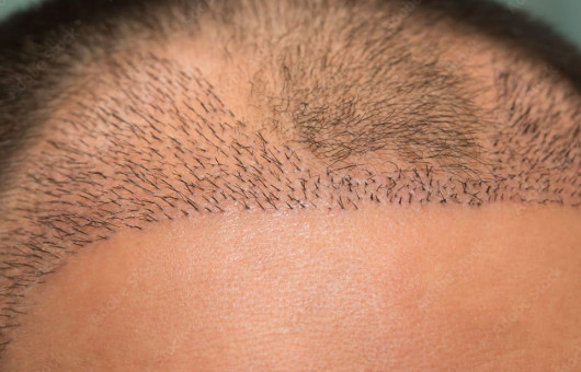 greffons de greffe de cheveux