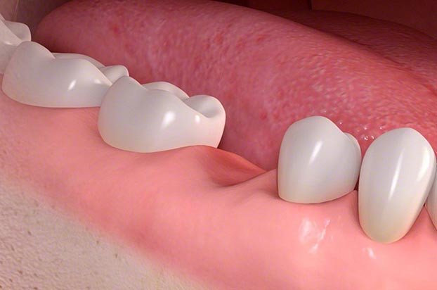 cicatrisation gingivale et osseuse