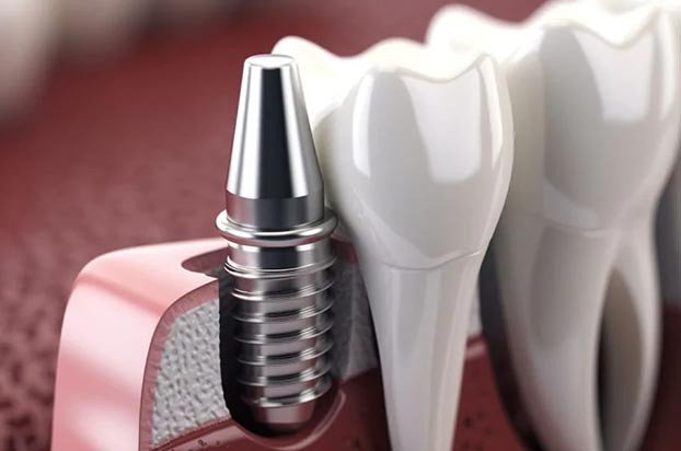pose de l'implant (phase chirurgicale)