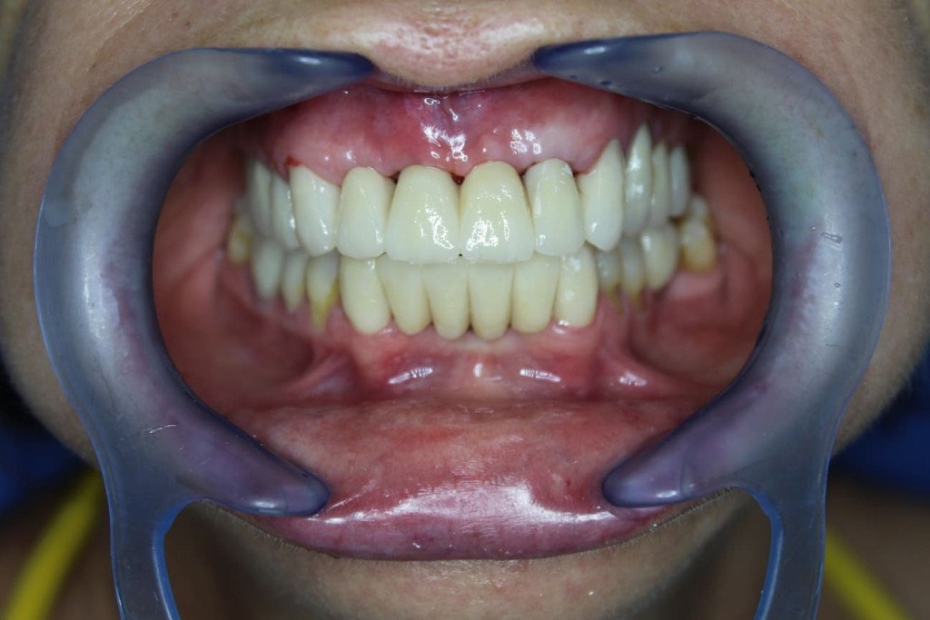 Restauration de la santé gingivale avec gencives et dents stabilisées après traitement parodontal