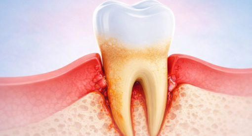 Illustration du déchaussement dentaire
