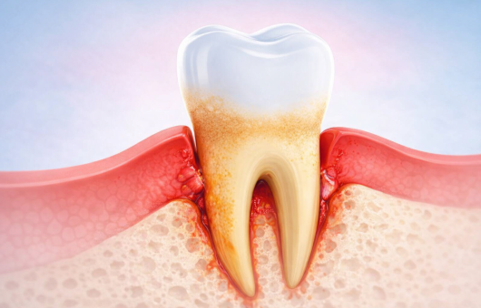 Illustration du déchaussement dentaire
